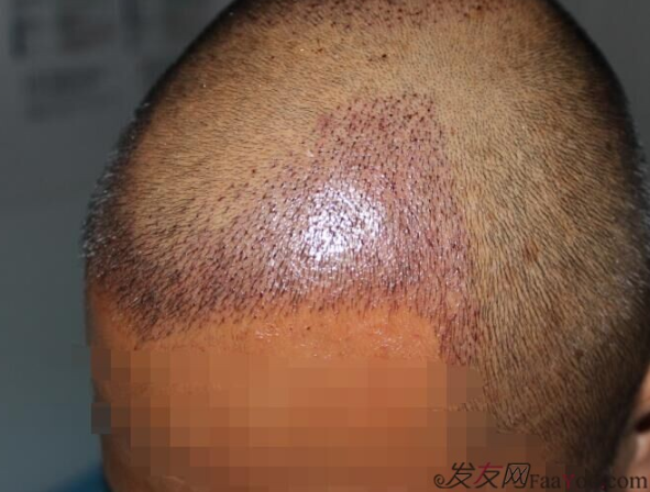 大麥微針植發(fā)3500單位，7個小時后我重拾年輕的心