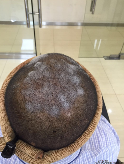 大麥微針植發(fā)3500單位，7個小時后我重拾年輕的心