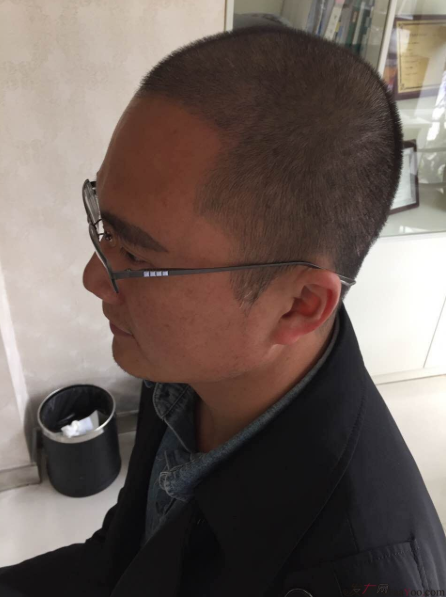 大麥微針植發(fā)3500單位，7個小時后我重拾年輕的心