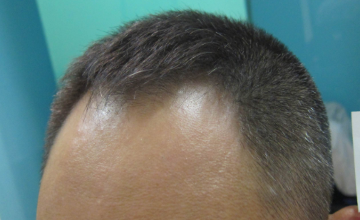 鄭州植發(fā)價(jià)格如何，有什么收費(fèi)項(xiàng)目嗎？