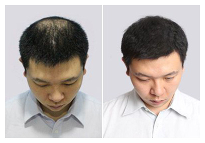 植發(fā)能夠維持多久？