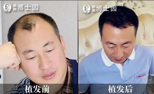 沈陽哪家植發(fā)醫(yī)院能讓發(fā)友更好的提高自身形象，需要多少費(fèi)用？