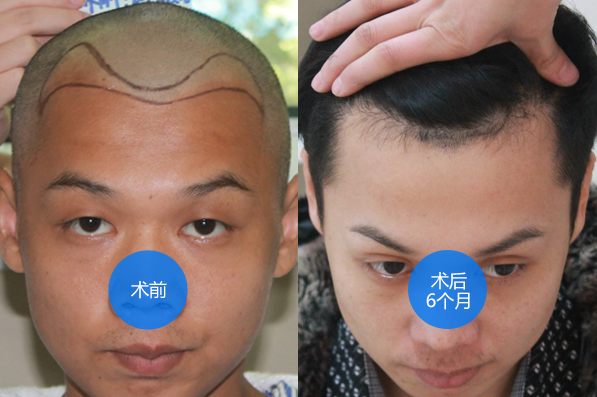 杭州時光發(fā)際線調(diào)整1500單位案例，看我術(shù)后六個月的效果圖