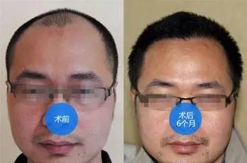 福州植發(fā)效果好不好？我在海峽植發(fā)3000單位來看看怎么樣