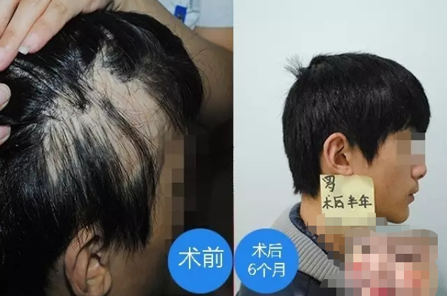 常州植發(fā)效果好不好？我是疤痕植發(fā)在常州百年植發(fā)的真實(shí)經(jīng)歷