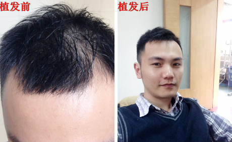 長(zhǎng)沙種植頭發(fā)3000單位案例，長(zhǎng)沙植發(fā)效果好不好