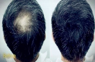 廣州植發(fā)貴不貴，看看我在新發(fā)現(xiàn)的植發(fā)效果怎么樣