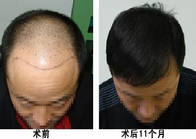 南昌植發(fā)效果如何？看看我在南昌植發(fā)4000單位效果圖