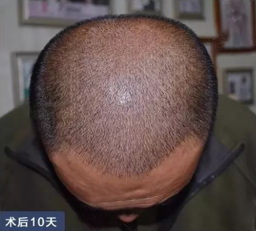 鄭州正規(guī)的植發(fā)醫(yī)院哪家比較好