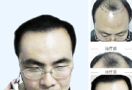 沈陽植發(fā)技術哪家好？我在牛大夫植發(fā)醫(yī)院植發(fā)3000單位來寫下心理歷程