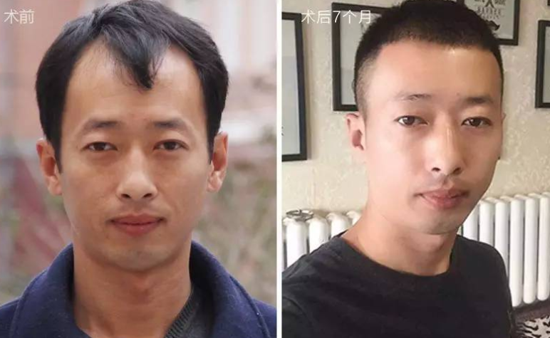 廈門新生植發(fā)醫(yī)院植發(fā)怎么樣，直述我在廈門新生m角種植七個月后