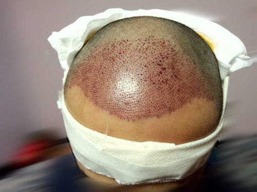 雍禾植發(fā)多少錢一個單位