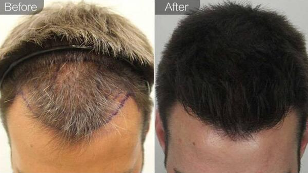 杭州植發(fā)多少錢？前額植發(fā)一年術(shù)后分享