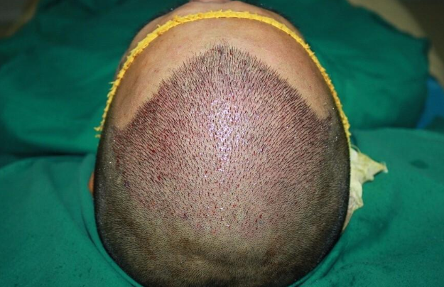 深圳植發(fā)一般需要多少錢呢？