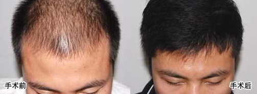 廣州植發(fā)多少錢？