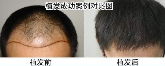 蘇州植發(fā)好不好，我在蘇州植發(fā)3000單位后的效果