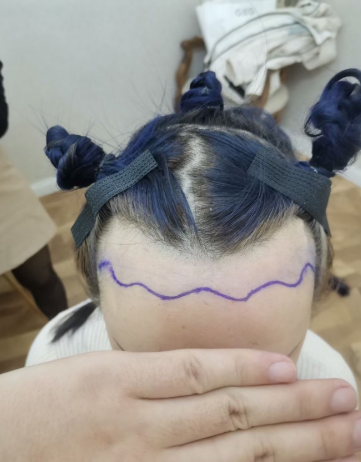 河北邯鄲植發(fā)2200單位，參加活動(dòng)后價(jià)格很滿意