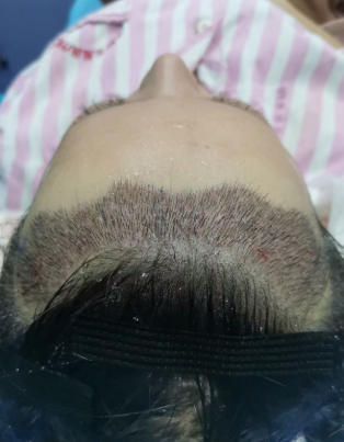 河北邯鄲植發(fā)2200單位，參加活動(dòng)后價(jià)格很滿意