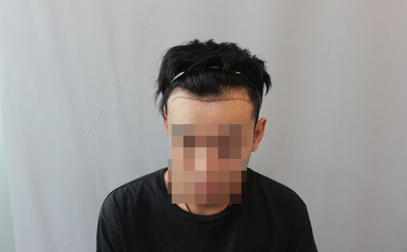 天津新發(fā)現(xiàn)發(fā)際線植發(fā)1500單位，看看術(shù)后恢復(fù)怎么樣