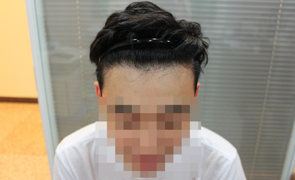 天津新發(fā)現(xiàn)發(fā)際線植發(fā)1500單位，看看術(shù)后恢復(fù)怎么樣