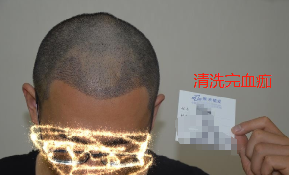 三級脫發(fā)在杭州進行植發(fā)手術(shù)，植發(fā)2000單位的術(shù)后感受
