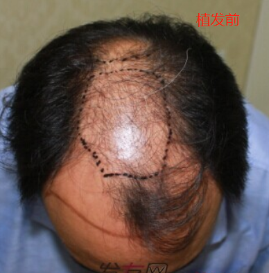 西安大麥微針植發(fā)3100單位，分享我的術(shù)后經(jīng)歷