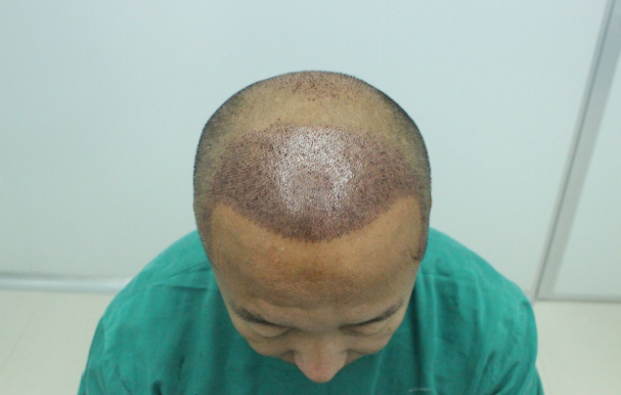 大麥微針植發(fā)3800單位真實(shí)經(jīng)歷分享，看看我的術(shù)后照片