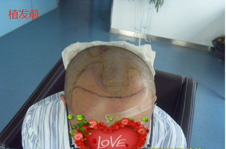 在西安做1800毛囊單位植發(fā)手術(shù)，期待術(shù)后蛻變