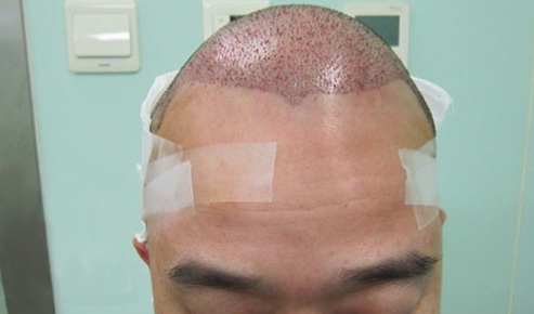 在北京植發(fā)3000單位，兒子孝敬我的，希望術(shù)后效果令我滿意