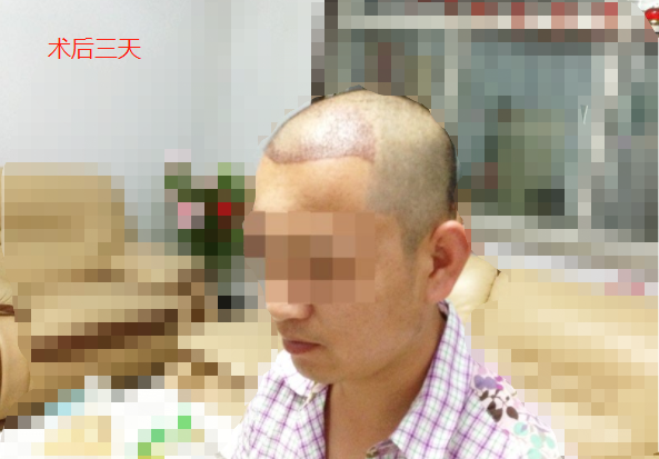 河北人在北京植發(fā)2500毛囊單位，看看術(shù)后效果怎么樣
