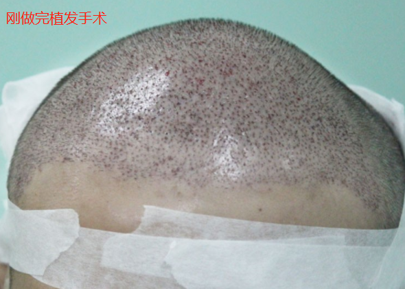 在北京植發(fā)2800單位，第二次植發(fā)手術(shù)期待術(shù)后效果