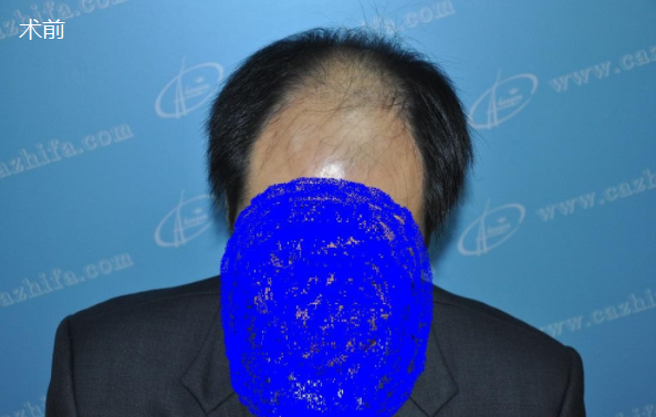 五級脫發(fā)植發(fā)經(jīng)歷，北京中美植發(fā)期待術(shù)后效果