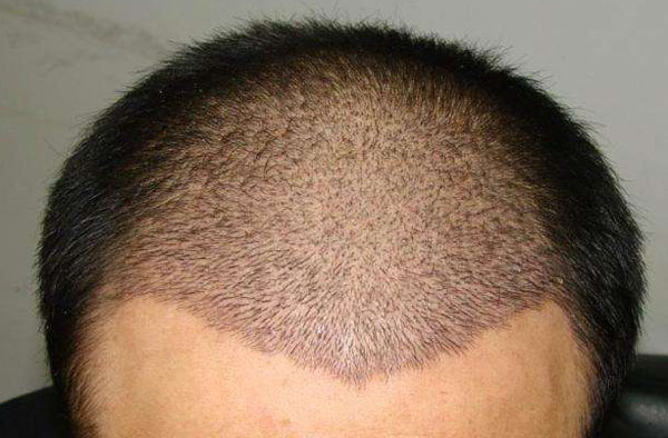 杭州植發(fā)需要多少錢