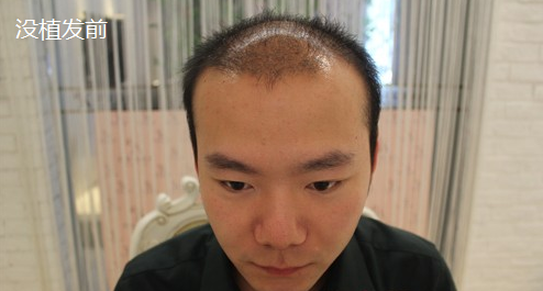 大麥微針植發(fā)4000單位，看看術(shù)后恢復(fù)情況怎么樣