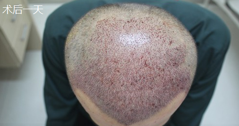 大麥微針植發(fā)4000單位，看看術(shù)后恢復(fù)情況怎么樣