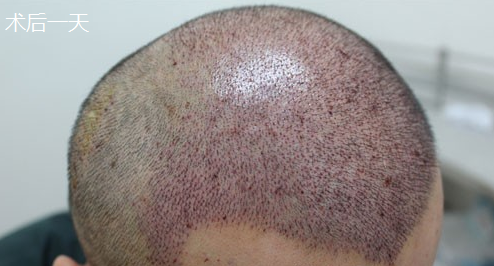 大麥微針植發(fā)4000單位，看看術(shù)后恢復(fù)情況怎么樣