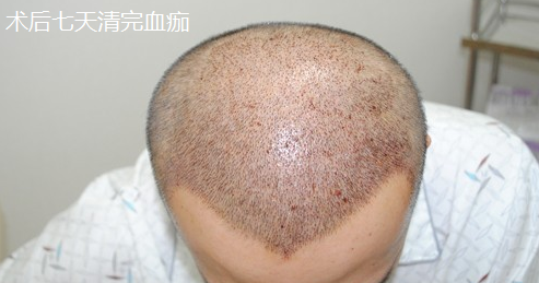 大麥微針植發(fā)4000單位，看看術(shù)后恢復(fù)情況怎么樣