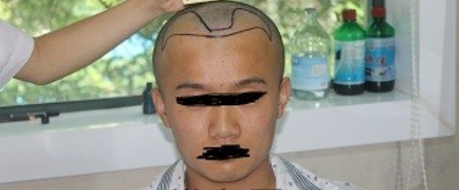 武漢雍禾植發(fā)2300單位，看我這個(gè)幸運(yùn)兒做完植發(fā)的效果