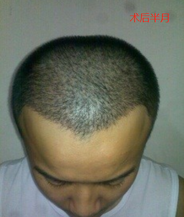 武漢雍禾植發(fā)2300單位，看我這個(gè)幸運(yùn)兒做完植發(fā)的效果