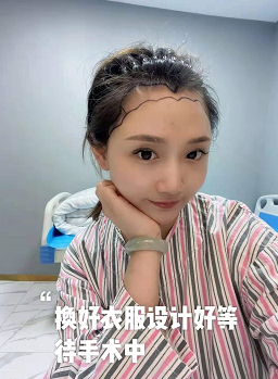 蘇州碧蓮盛植發(fā)3000單位，終于邁出這一步期待術(shù)后效果！