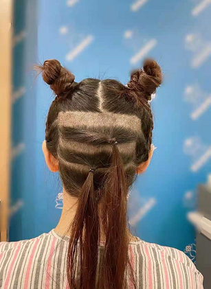 蘇州碧蓮盛植發(fā)3000單位，終于邁出這一步期待術(shù)后效果！