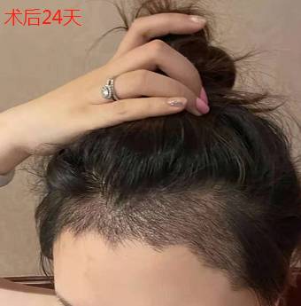 蘇州碧蓮盛植發(fā)3000單位，終于邁出這一步期待術(shù)后效果！