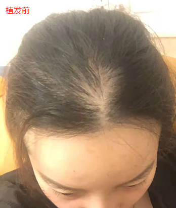 廈門雍禾植發(fā)2500單位毛囊，期待術(shù)后可以有更好的改變