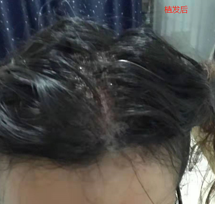 廈門雍禾植發(fā)2500單位毛囊，期待術(shù)后可以有更好的改變