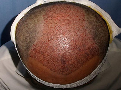 南昌大麥頭頂加密植發(fā)3500單位后，我發(fā)生了什么改變？