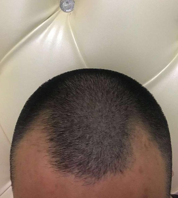 植發(fā)術(shù)前照片