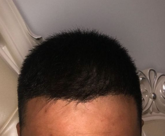 植發(fā)術(shù)后八個(gè)月