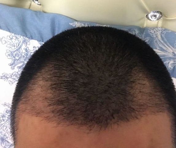 植發(fā)第22天