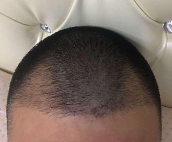 植發(fā)3個(gè)月