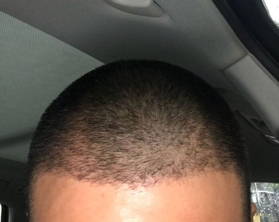 植發(fā)術(shù)后半年